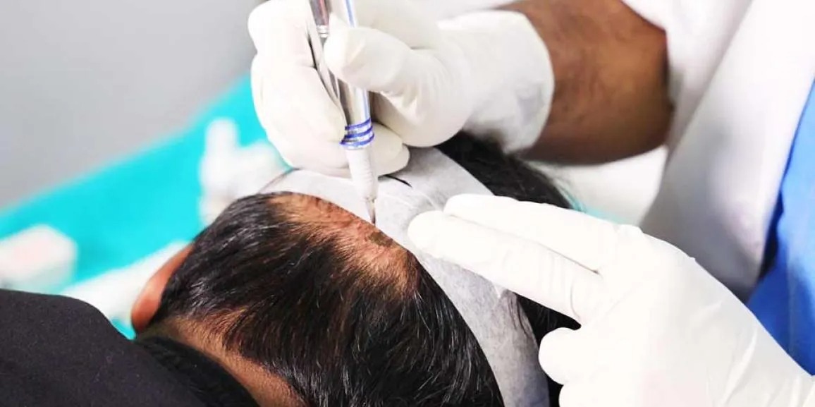 Hair Transplant Istanbul: Affordable Luxury for Hair Restoration