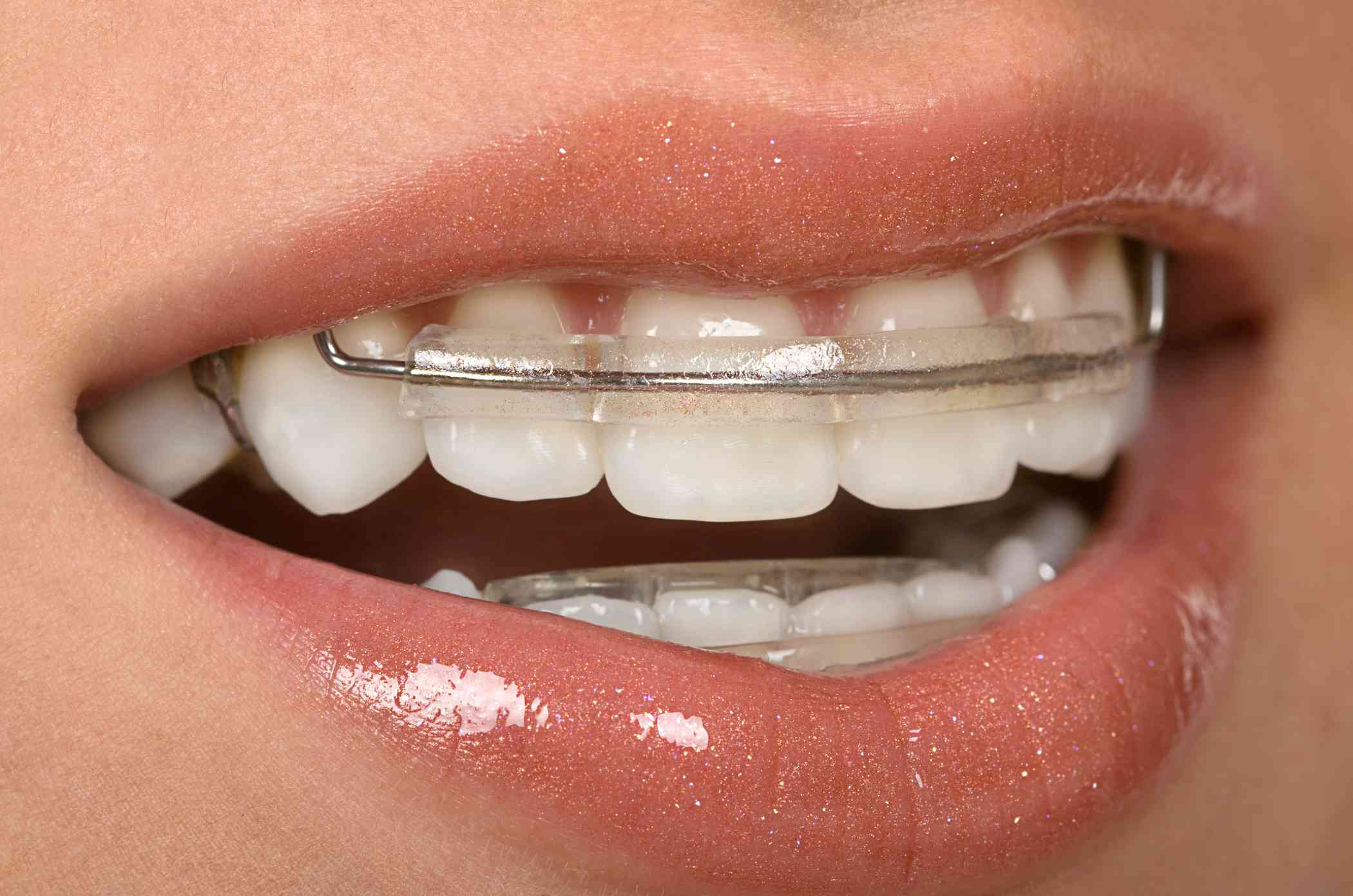 Ceramic Braces vs Metal Braces: Which Is Better for You?